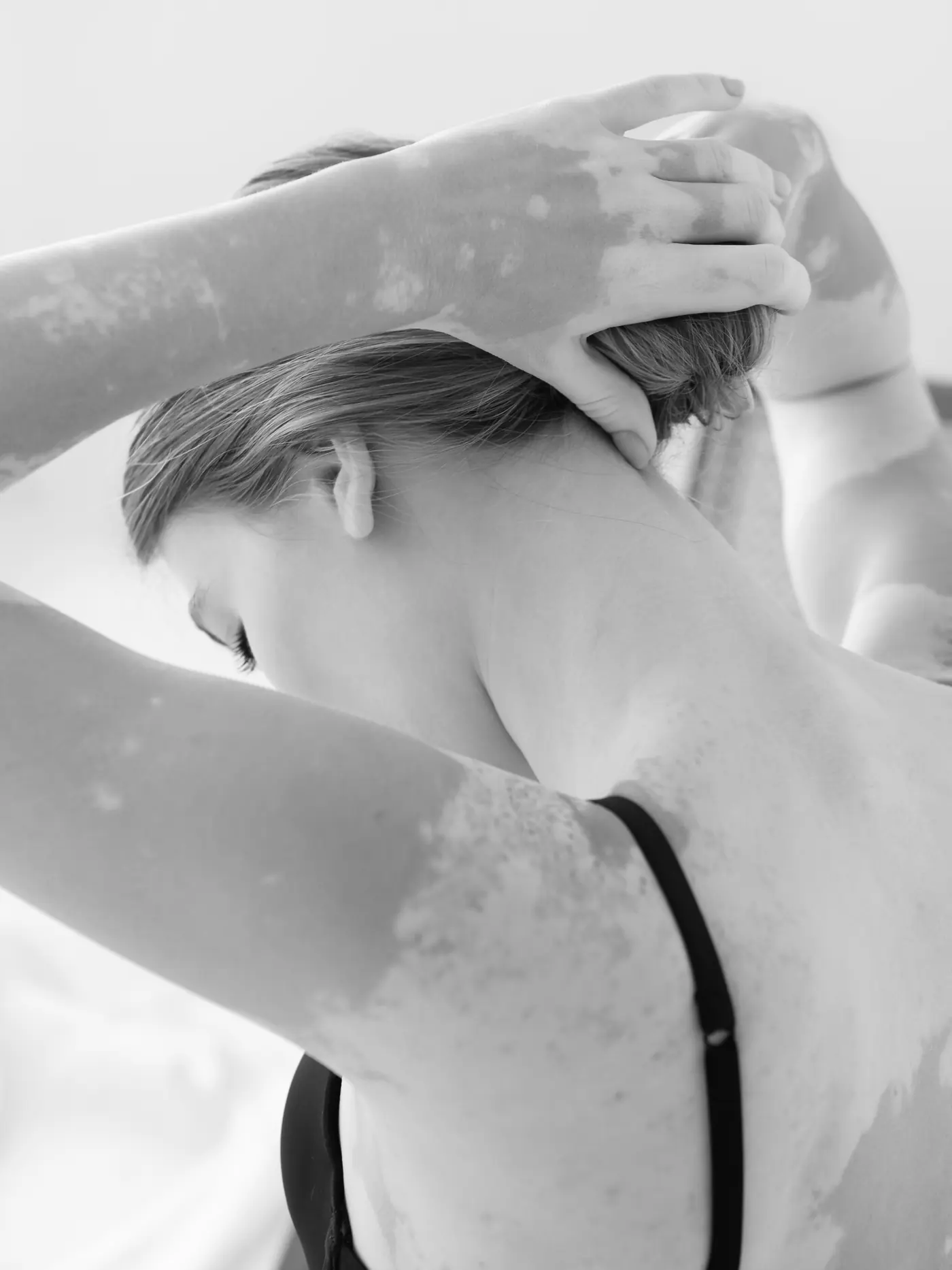 Vitiligo-Pigmentierung: Porträt einer jungen Frau mit Weißfleckenkrankheit, schwarzweiß fotografiert