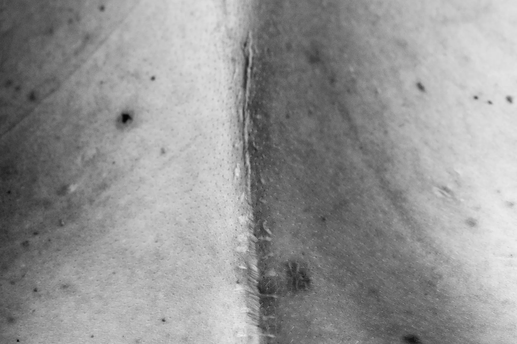Narbenpigmentierung: Rücken mit einer langen Operationsnarbe, schwarzweiß fotografiert