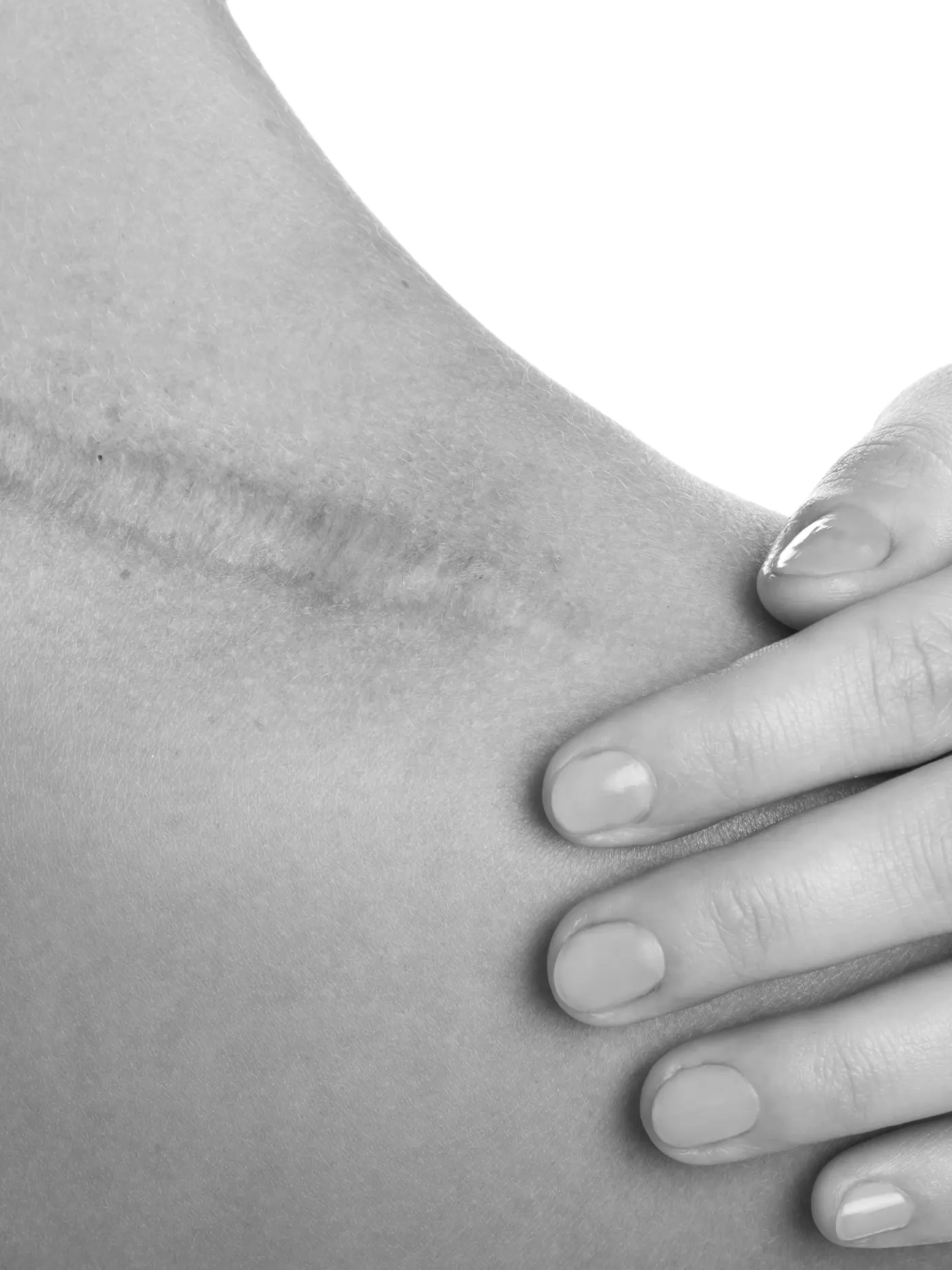 Areola-Pigmentierung nach Brustkrebs: Schulter und Dekolleté mit verheilter Operationsnarbe, schwarzweiß fotografiert