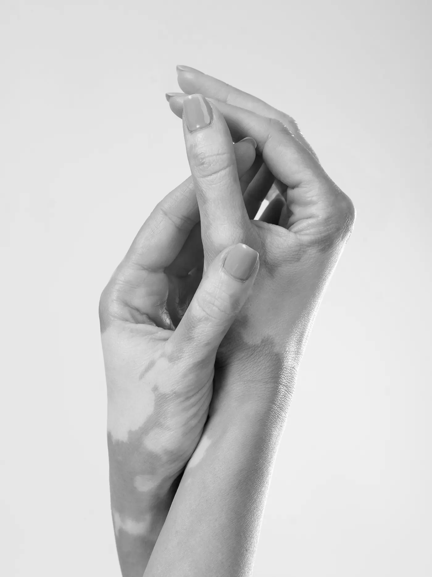 Vitiligo-Pigmentierung: Arm mit weißen Flecken, schwarzweiß fotografiert
